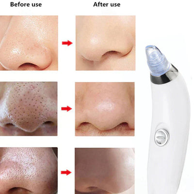 Gawadar Import™ 4 in 1 Derma Blackhead Remover Machine